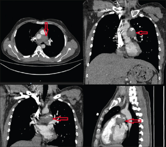 A case presented with fever enlightened by cardiac auscultation: Sarcoma originated in pulmonary artery.