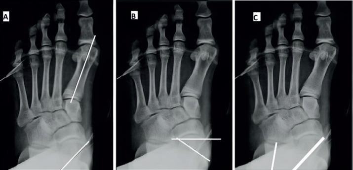 Subtalar Arthroereisis for Symptomatic Flexible Flatfoot in Adolescents: A Prospective Study of 26 Feet.