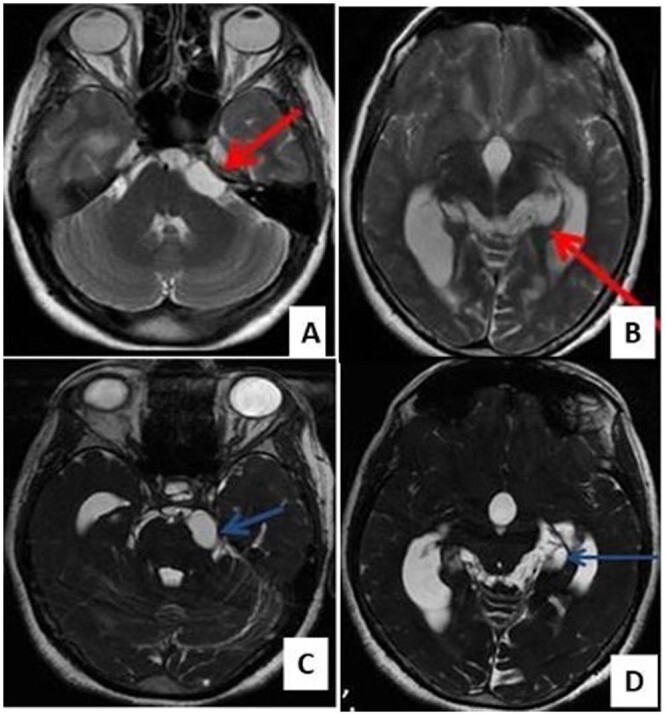 Racemose neurocysticercosis: a case series.