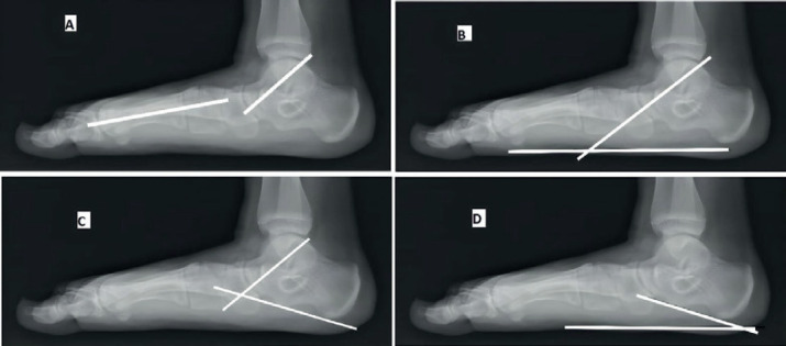 Subtalar Arthroereisis for Symptomatic Flexible Flatfoot in Adolescents: A Prospective Study of 26 Feet.