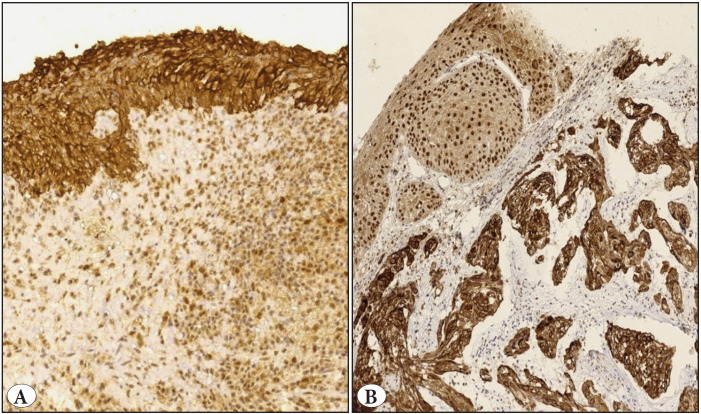Immunohistochemical Expression of Vitamin D Receptor (VDR) in Urinary Bladder Squamous Cell Carcinoma.