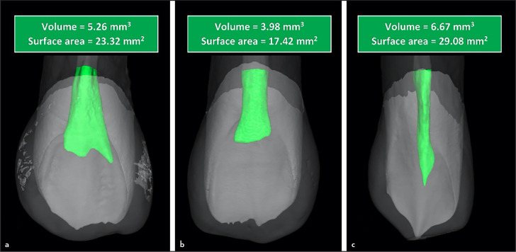 A Proposal to Develop a New Classification for Pulp Chamber Anatomy.