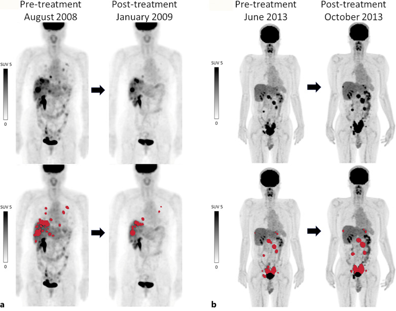Predictive Factors of Early 18F-Fluorodeoxyglucose-Positron Emission Tomography Response to [131I] Metaiodobenzylguanidine Treatment for Unresectable or Metastatic Pheochromocytomas and Paragangliomas.