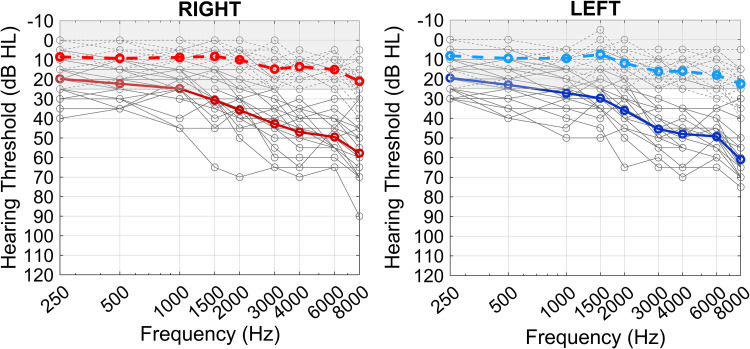 A Step Toward Precision Audiology: Individual Differences and Characteristic Profiles From Auditory Perceptual and Cognitive Abilities.