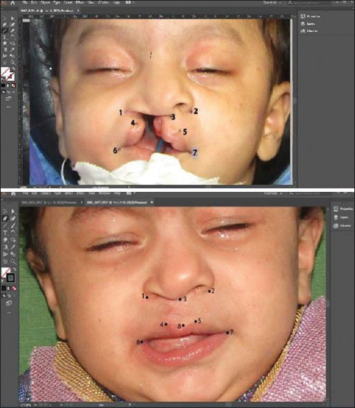 The Outcomes of Modified Millard Technique Versus Tennison-Randall Technique in Unilateral Cleft Lip Repair: A Comparative Trial.