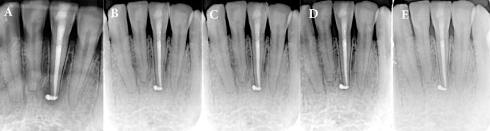 Guided Endodontic Treatment of Mandibular Incisor with Pulp Canal Obliteration following Dental Trauma: A Case Report.