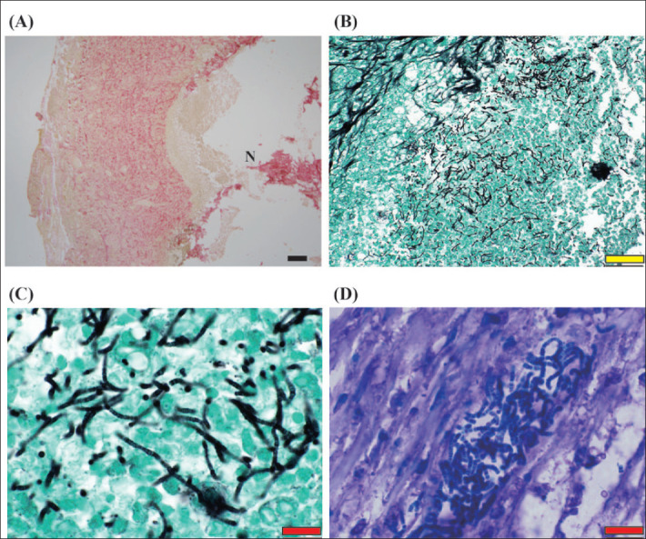 Granulomatous Myocarditis Caused by Candida Spp Infection in a Spontaneously Diabetic Torii Rat.