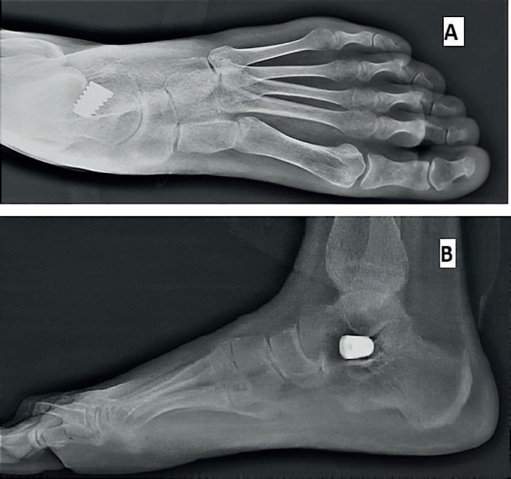 Subtalar Arthroereisis for Symptomatic Flexible Flatfoot in Adolescents: A Prospective Study of 26 Feet.