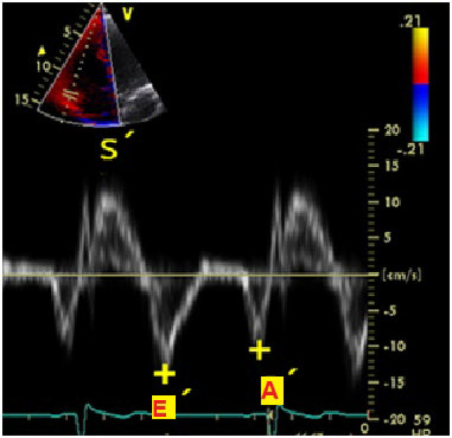 Evaluation of the prevalence and predictors of right ventricular diastolic dysfunction in patients undergoing coronary artery bypass surgery.