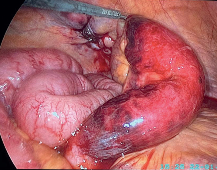 Spigelian Hernia in Cirrhotic Patients: When and How to Repair?