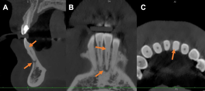 Guided Endodontic Treatment of Mandibular Incisor with Pulp Canal Obliteration following Dental Trauma: A Case Report.