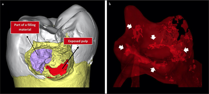 A Proposal to Develop a New Classification for Pulp Chamber Anatomy.