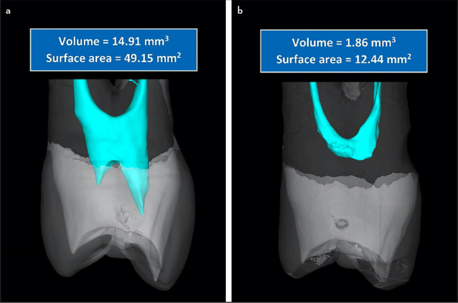 A Proposal to Develop a New Classification for Pulp Chamber Anatomy.