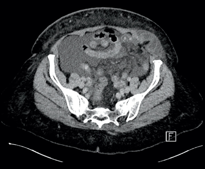 Spigelian Hernia in Cirrhotic Patients: When and How to Repair?