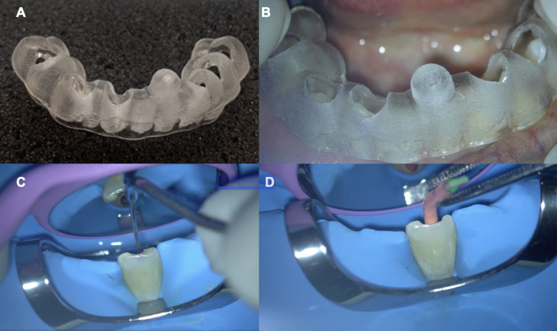 Guided Endodontic Treatment of Mandibular Incisor with Pulp Canal Obliteration following Dental Trauma: A Case Report.