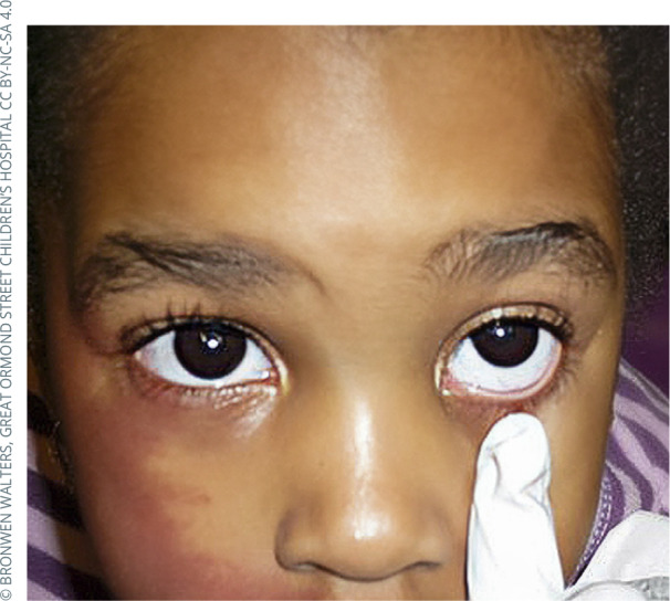 Cycloplegic refraction in children.