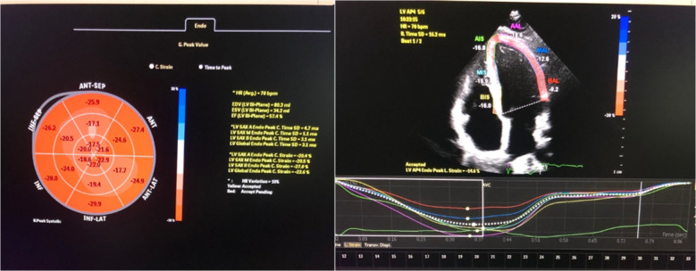 Evaluation of the early effect of elective percutaneous coronary intervention on left ventricular diastolic and systolic function.