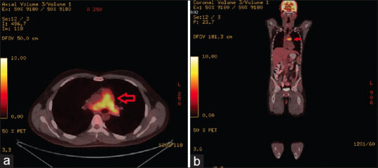A case presented with fever enlightened by cardiac auscultation: Sarcoma originated in pulmonary artery.