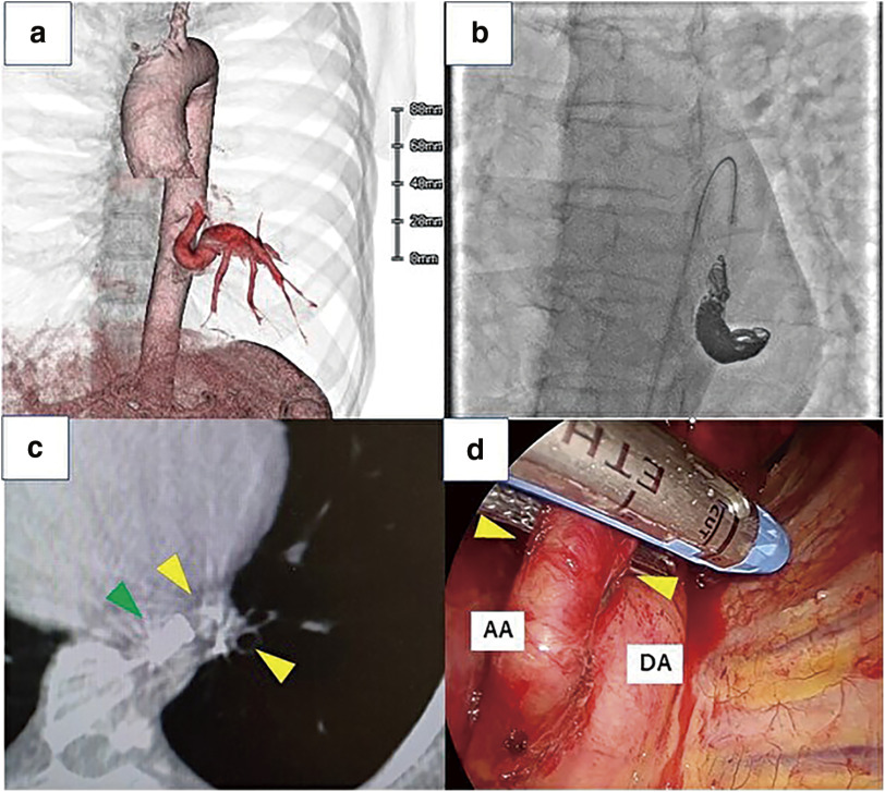 Arterial Embolization and Cone-Beam Computed Tomography-Guided Lung Resection for Anomalous Systemic Arterial Blood Supply to Normal Lung: Two Case Reports.