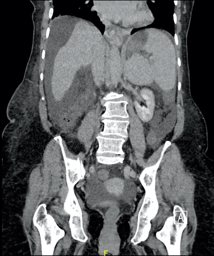 Spigelian Hernia in Cirrhotic Patients: When and How to Repair?