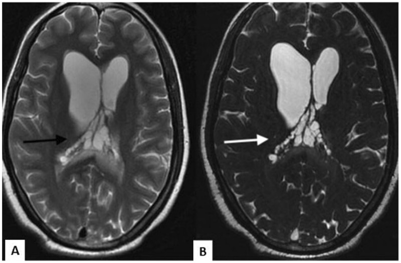 Racemose neurocysticercosis: a case series.