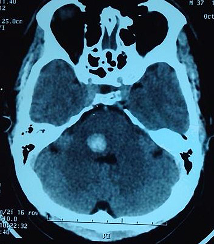 Bites and Stings: Exotic Causes of Stroke in Asia.