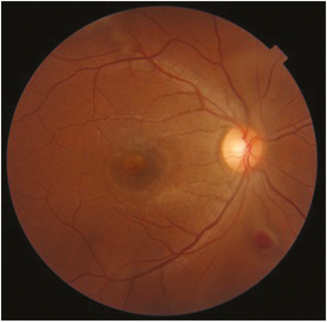 Full Thickness Macular Hole in Aesthetician Occurring Due to Accidental Self-exposure to Cosmetic Laser Machine Trying to Take Special Precautions Against COVID-19.