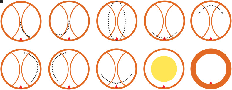 Holmium Laser Enucleation of Prostate: Is novel En Bloc Enucleation Technique Better Than the Traditional 2-Lobe Technique-A Prospective Randomized Study.