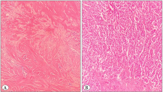 Investigation of the Relationship Between Tumor Microenvironment and Prognostic Parameters in Invasive Breast Carcinomas of No Special Type: A Retrospective Analysis.