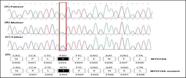 A Novel Deleterious MYO15A Gene Mutation Causes Nonsyndromic Hearing Loss.