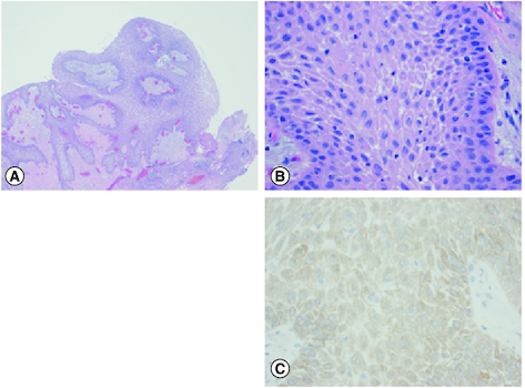 Promising response to vemurafenib and cobimetinib treatment for BRAF V600E mutated craniopharyngioma: a case report and literature review.