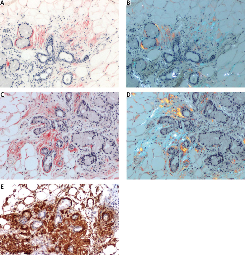 Higher detectability of amyloid with phenol Congo red compared with alkaline Congo red.
