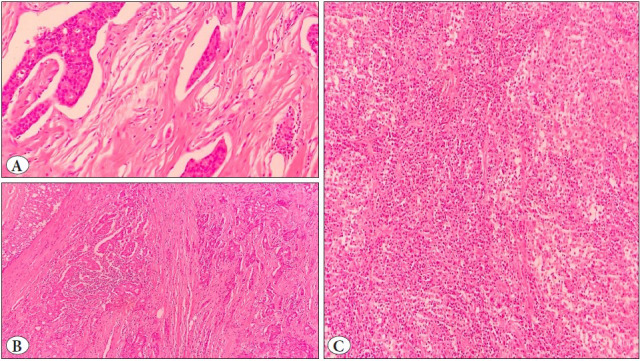 Investigation of the Relationship Between Tumor Microenvironment and Prognostic Parameters in Invasive Breast Carcinomas of No Special Type: A Retrospective Analysis.