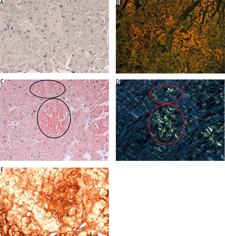 Higher detectability of amyloid with phenol Congo red compared with alkaline Congo red.