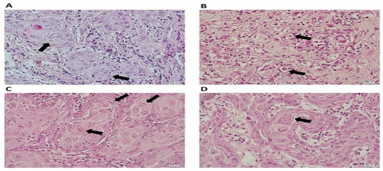 Cell Cannibalism in Oral Precancerous Lesions and Squamous Cell Carcinoma.