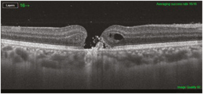 Full Thickness Macular Hole in Aesthetician Occurring Due to Accidental Self-exposure to Cosmetic Laser Machine Trying to Take Special Precautions Against COVID-19.