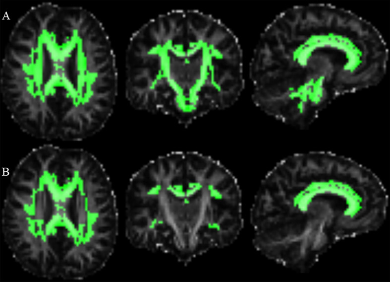 White Matter Microstructure Changes Revealed by Diffusion Kurtosis and Diffusion Tensor Imaging in Mutant Huntingtin Gene Carriers.