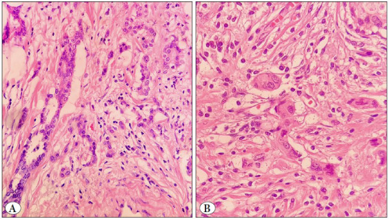 Investigation of the Relationship Between Tumor Microenvironment and Prognostic Parameters in Invasive Breast Carcinomas of No Special Type: A Retrospective Analysis.