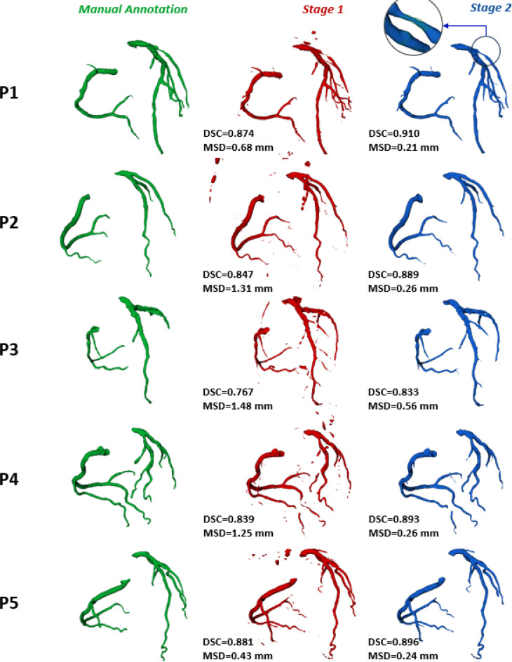 A fully automated deep learning approach for coronary artery segmentation and comprehensive characterization.