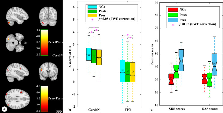 Reversibility of Impaired Large-Scale Functional Brain Networks in Cushing's Disease after Surgery Treatment: A Longitudinal Study.