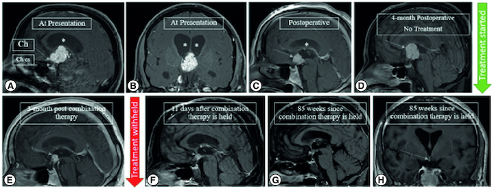 Promising response to vemurafenib and cobimetinib treatment for BRAF V600E mutated craniopharyngioma: a case report and literature review.