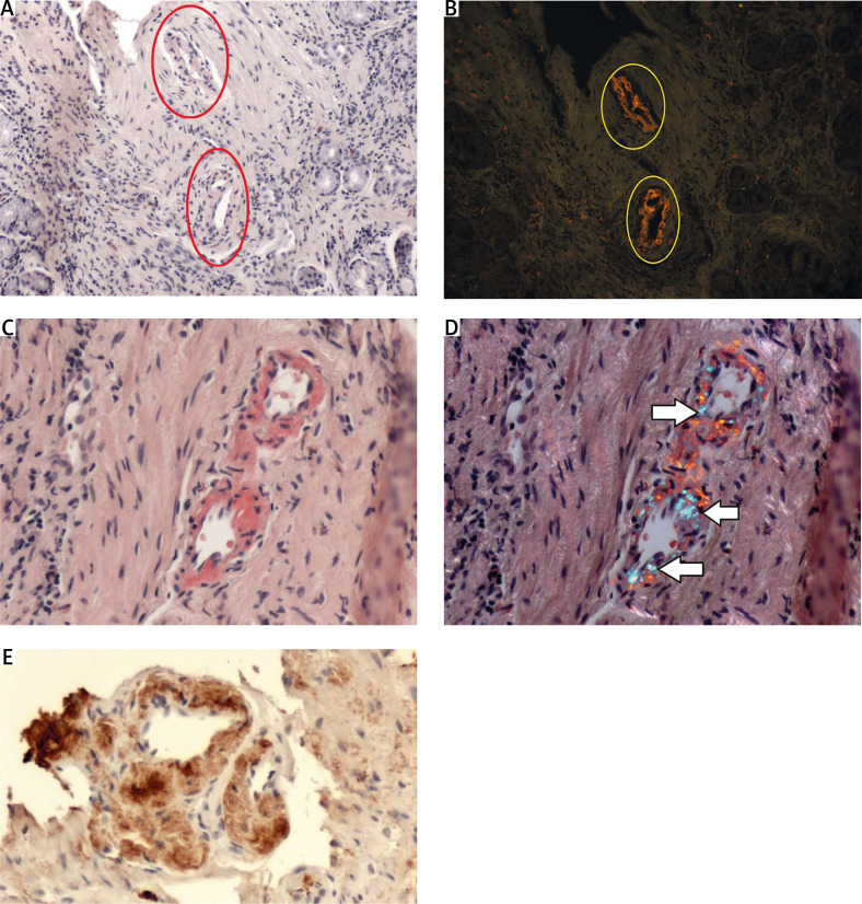 Higher detectability of amyloid with phenol Congo red compared with alkaline Congo red.