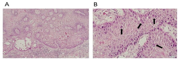 Cell Cannibalism in Oral Precancerous Lesions and Squamous Cell Carcinoma.