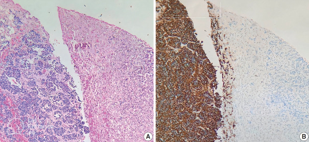 Immunohistochemical expression of anaplastic lymphoma kinase in neuroblastoma and its relations with some clinical and histopathological features.