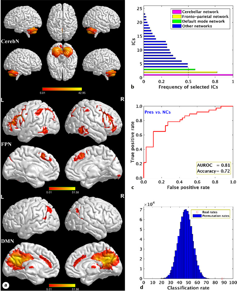 Reversibility of Impaired Large-Scale Functional Brain Networks in Cushing's Disease after Surgery Treatment: A Longitudinal Study.