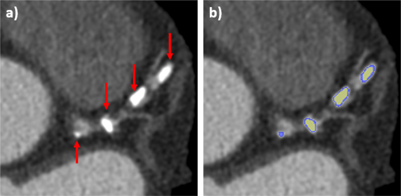 A fully automated deep learning approach for coronary artery segmentation and comprehensive characterization.