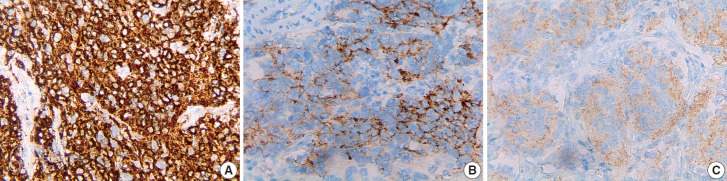 Immunohistochemical expression of anaplastic lymphoma kinase in neuroblastoma and its relations with some clinical and histopathological features.