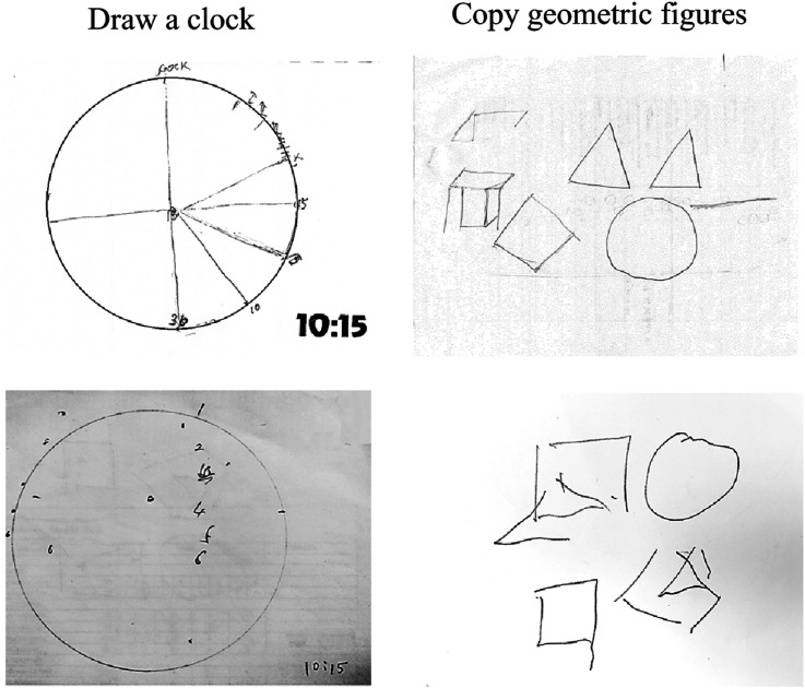 Effects of a Hybrid Model of Occupational Therapy on Visuospatial Perception and Functional Skills for Cases With Posterior Cortical Atrophy: A Five-Case Report.
