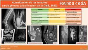 Actualización de los tumores cartilaginosos según la clasificación de la OMS de 2020