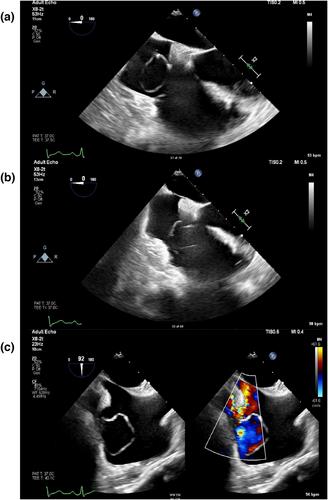 Anaesthetic management of a parturient with an unrepaired coronary arteriovenous fistula for caesarean section